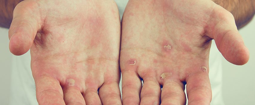 How Can I Keep My Skin Healthy When It Gets Cold Outside?